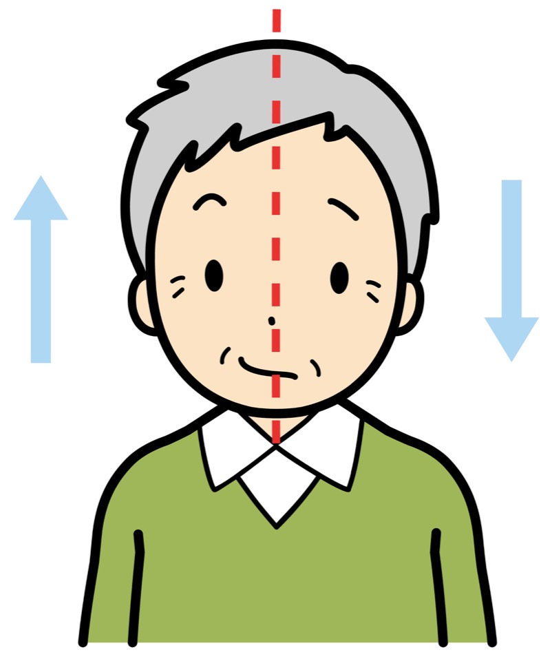 顔の左半分も麻痺？