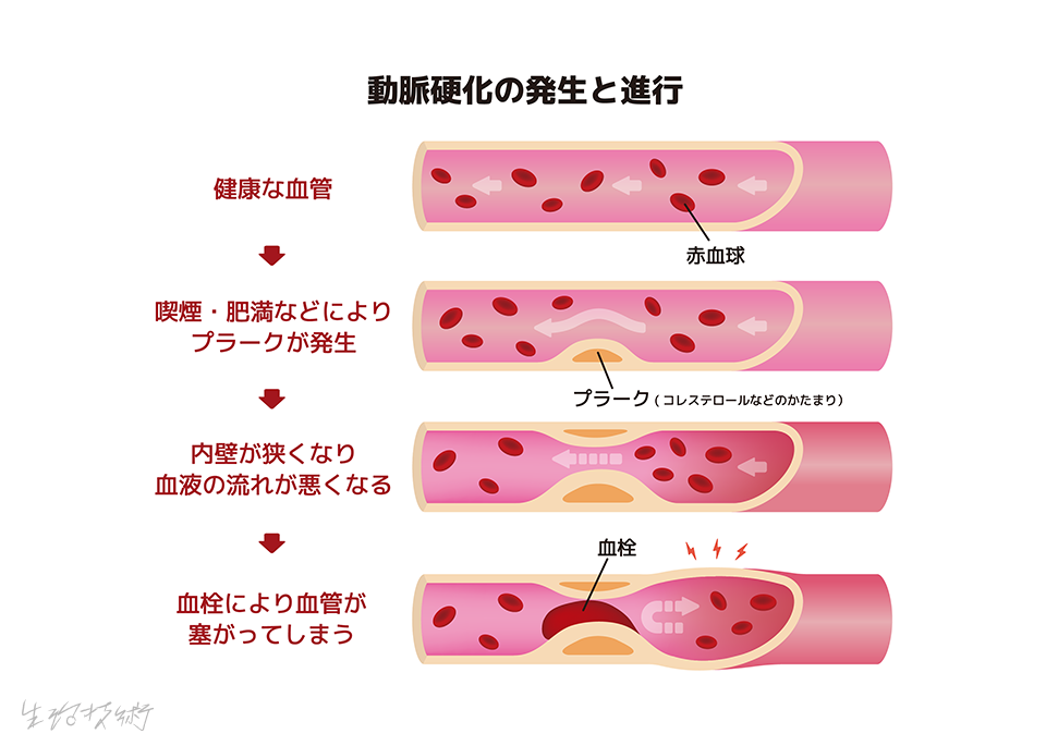 脳梗塞時の血管の症状